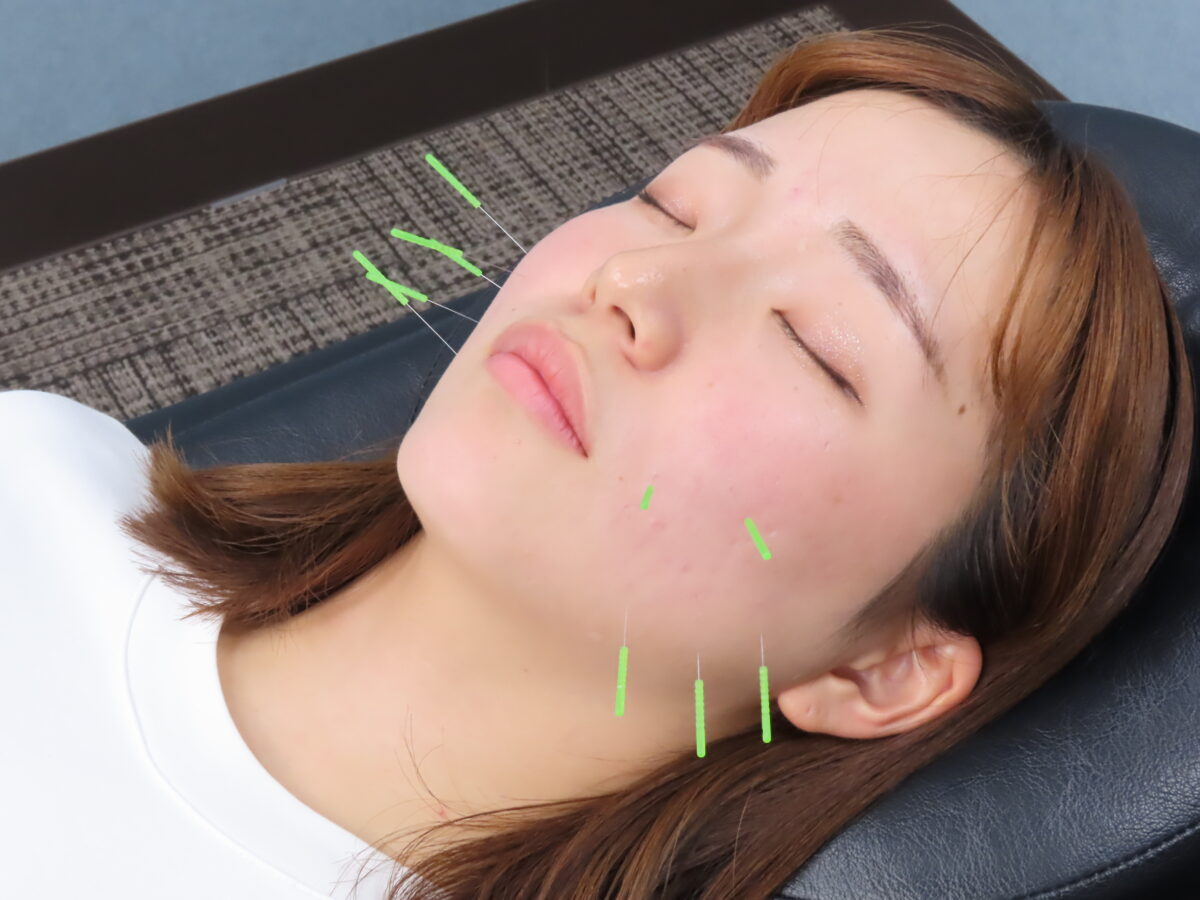 美容鍼